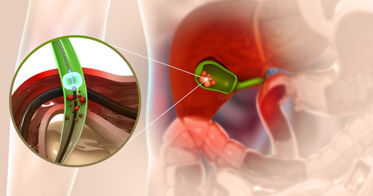 Illustration der Gallenblase und Gallensteine mit detaillierter Darstellung der Entfernung durch ein medizinisches Verfahren.