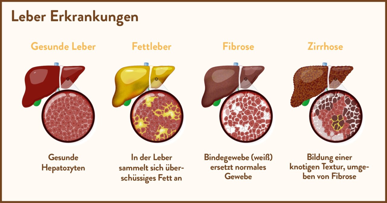 Leber Erkrankungen