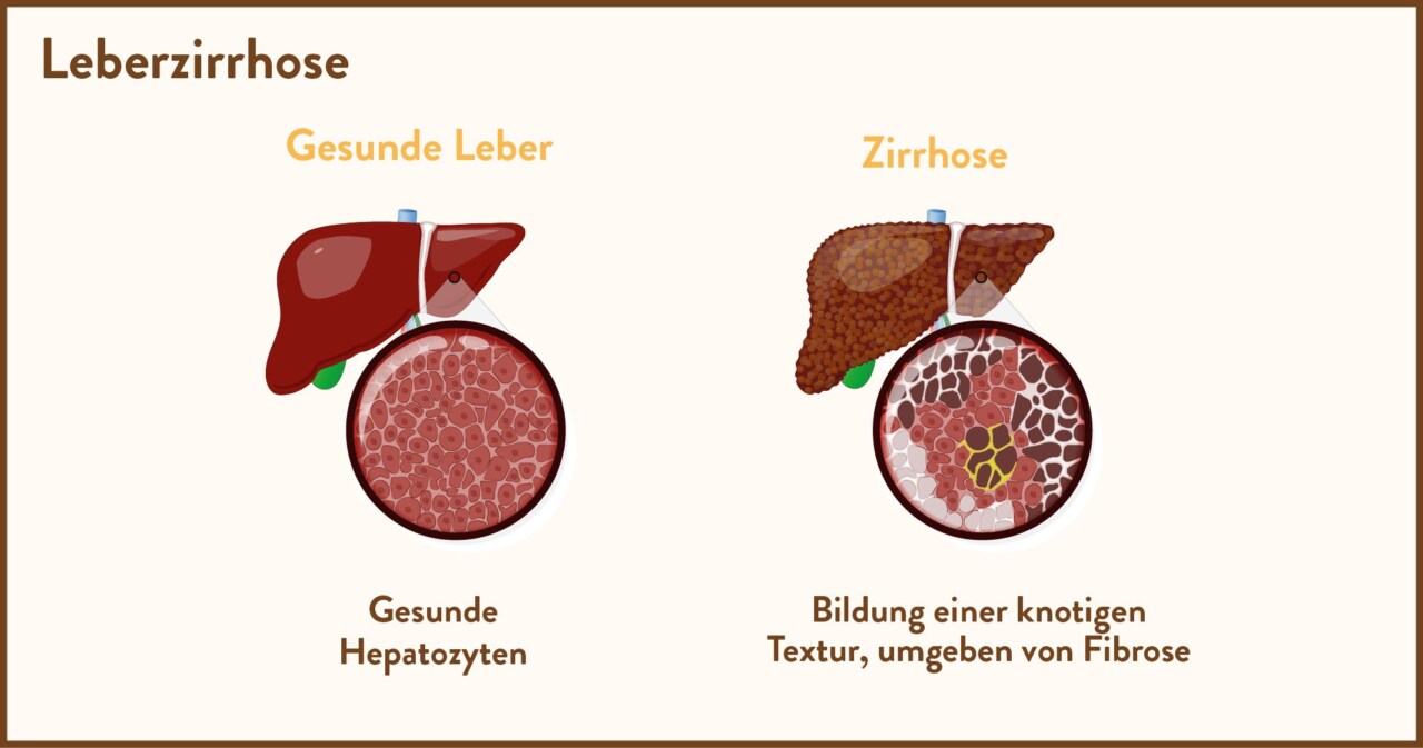 Leberzirrhose