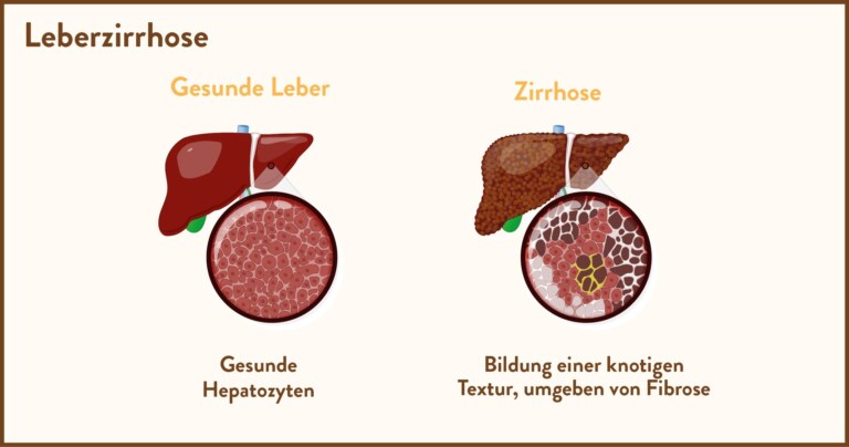Leberzirrhose: Ursachen, Symptome und Behandlung - LeberGesundheit.org