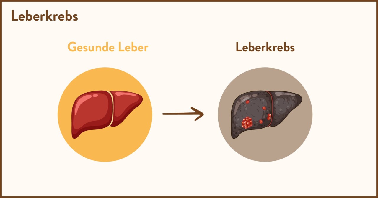 Leberkrebs