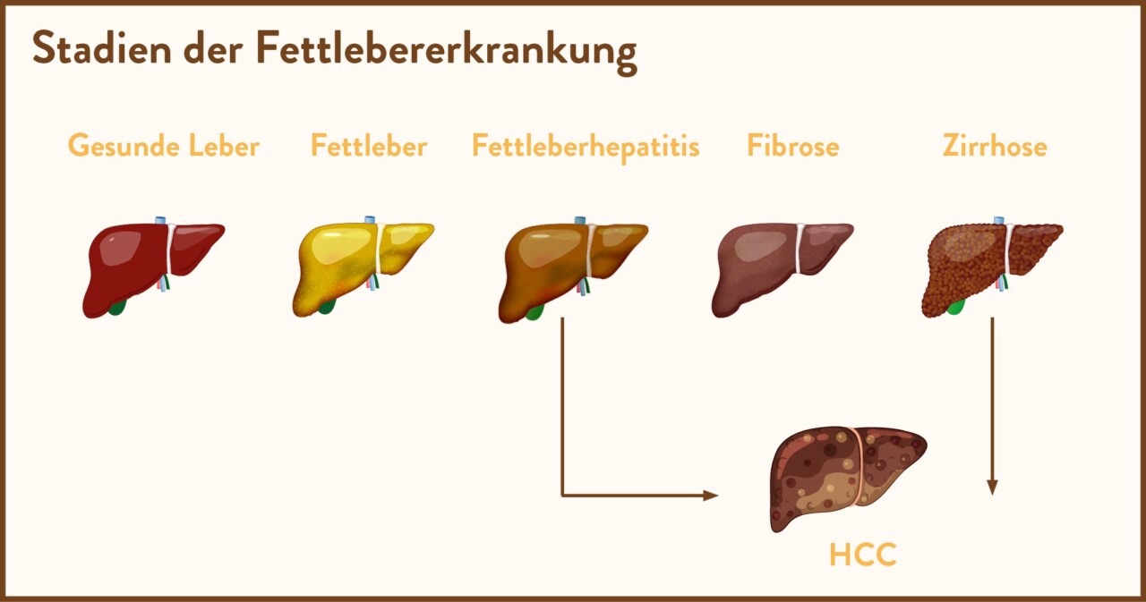 Infografik der Stadien der Fettlebererkrankung von gesunder Leber bis hin zu Zirrhose und Leberkrebs (HCC).