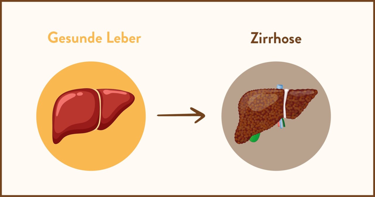 Vergleich: Gesunde und zirrhotische Leber